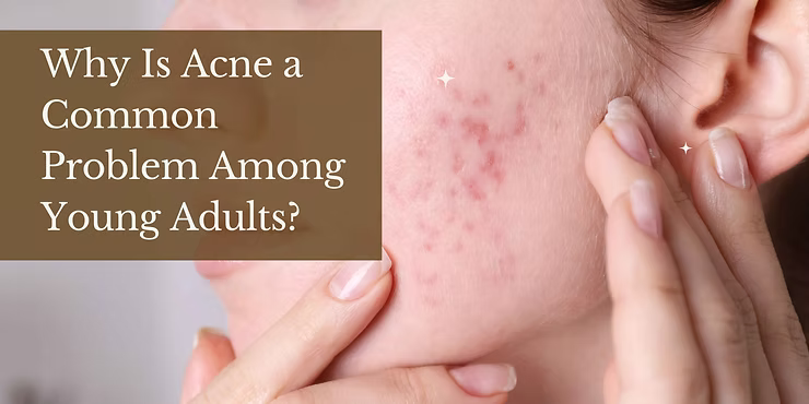 Why Is Acne a Common Problem Among Young Adults?