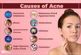 How to Control Acne Naturally