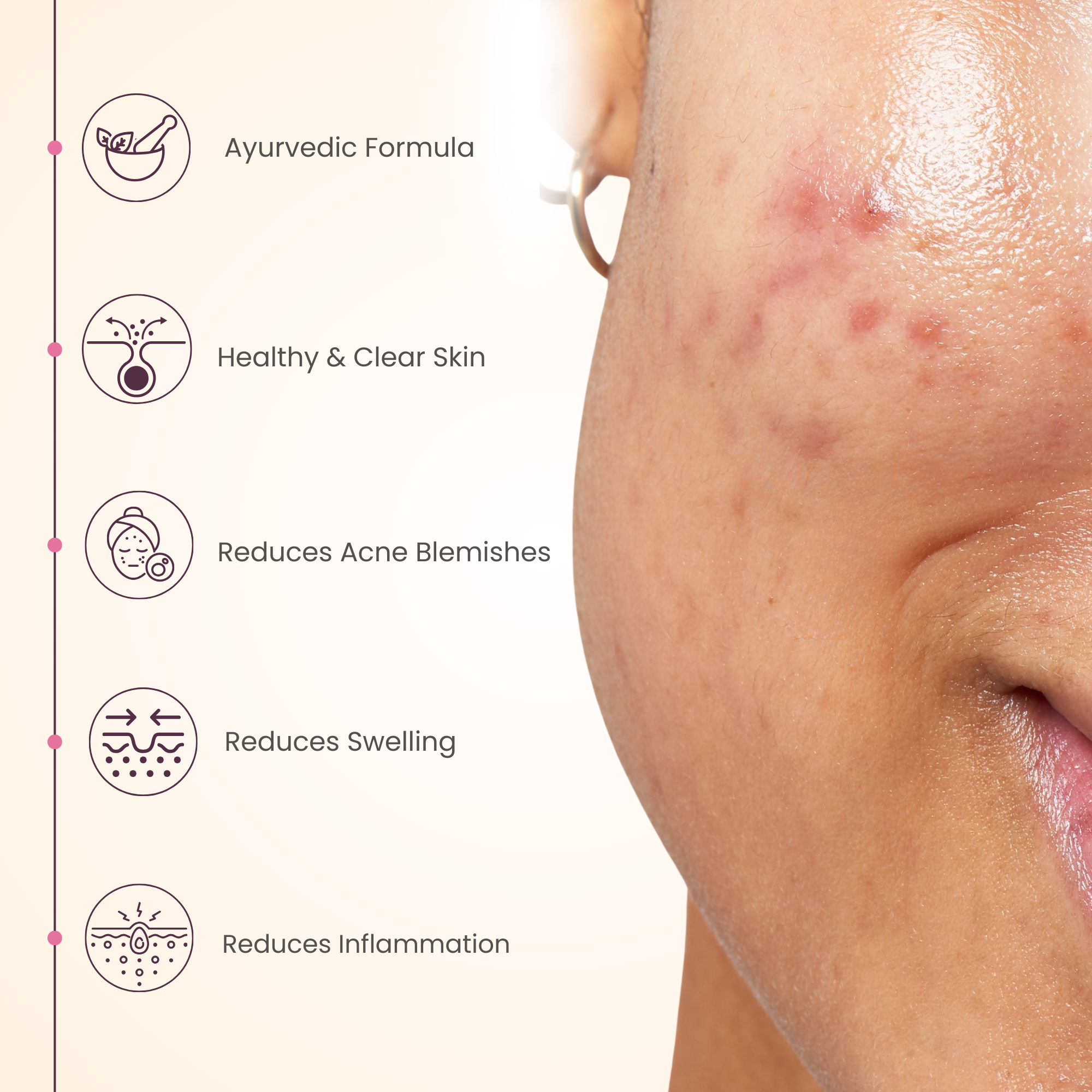 Acne Control Gel 50 gm For Clear, Healthy Skin